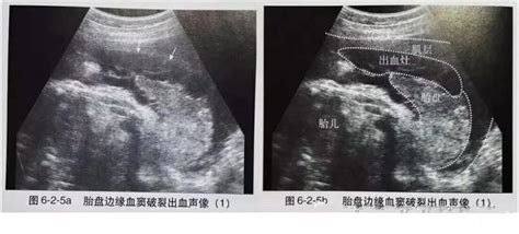 胎盤剝離後期